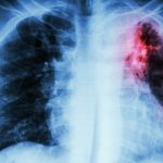 TB-xray